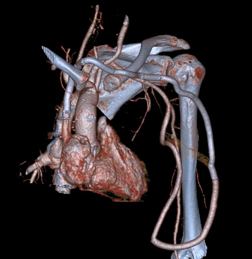 CTA follow up 3D reconstruction