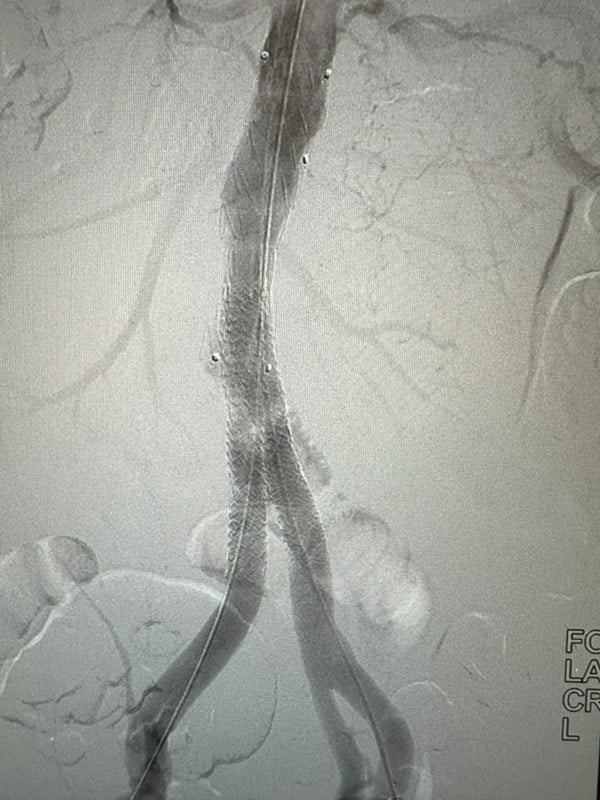 Final angiography