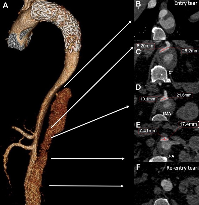 Figure 1. CTA 3D reconstruction (A) with true lumen aortic diameters at the level of visceral vessels according to SVS reporting standards (C-D-E). Proximal and distal entry tears are also shown (B-F).  