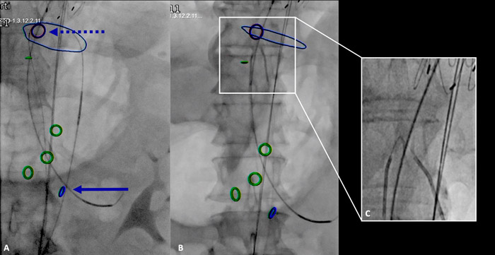 Figure 2. Static fluoroscopy image showing the true-false lumen through-and-through guidewire 