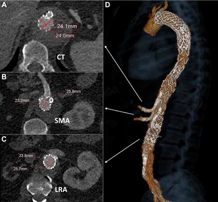 Figure 4. Axial postprocedure computed tomography angiogram (CTA) of the aorta at the celiac trunk (CT) level