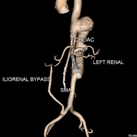 Atypical aortic pseudoaneurysm: Image 1