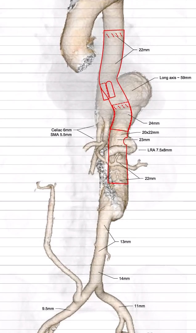 Atypical aortic pseudoaneurysm: Image 2