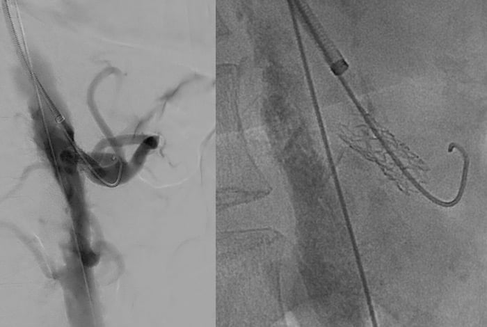 Stenting of the aorta (BMS, 12x60 mm GPS) and chimney for the celiac artery (7x22 mm, Advanta V12) 