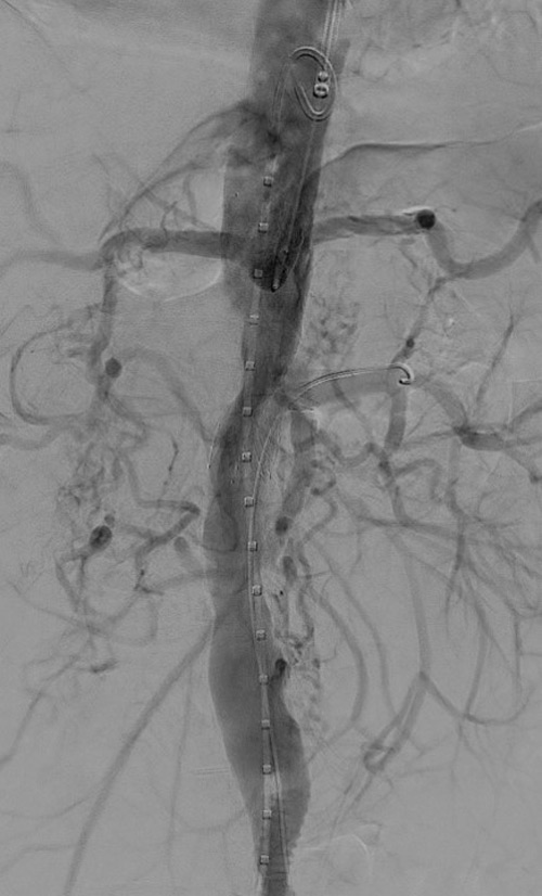 Angio: retrograde filling of SMA  Good patency of aorta, celiac and renal artery