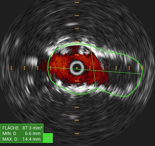 IVUS