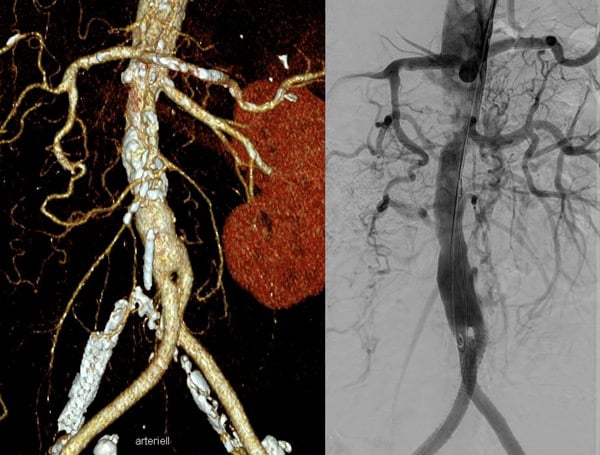 68-year-old woman with visceral ischemia