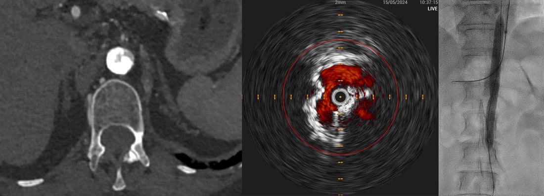 Shockwave lithotripsy of the severe calcified visceral aorta