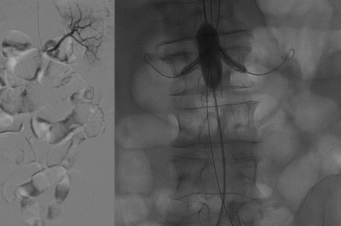 Recanalization of both limbs