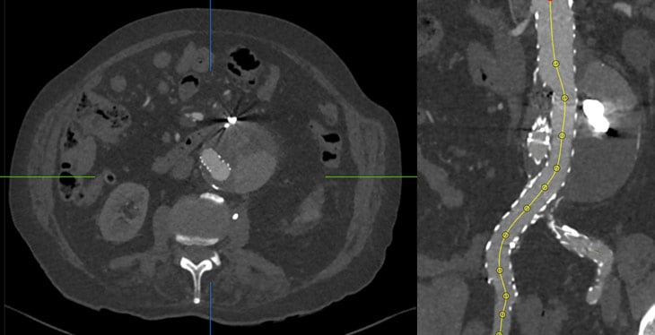 - 2024: AAA 80 mm, large Type II endoleak (unclear on CT imaging)