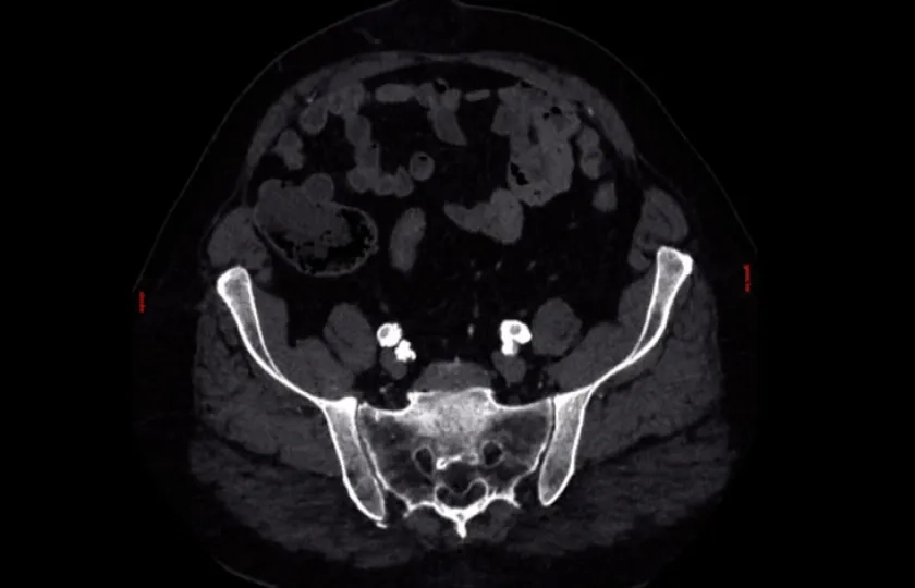 IVL in PAD: crossing calcified lesions