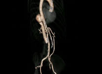 Atypical aortic pseudoaneurysm: How best to treat ?