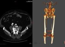 PAD with highly selective treatment for CLTI