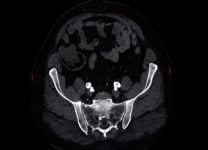 IVL in PAD: crossing calcified lesions