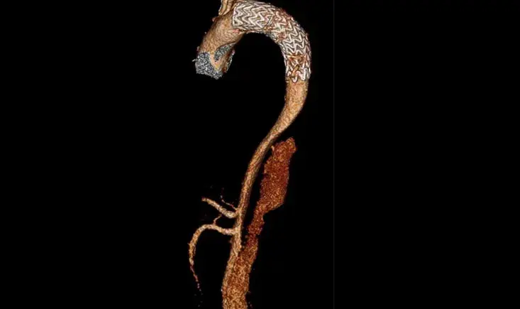 How to tackle narrow paravisceral true lumen during post-dissection thoraco-abdomimal aortic aneurysm endovascular repair 