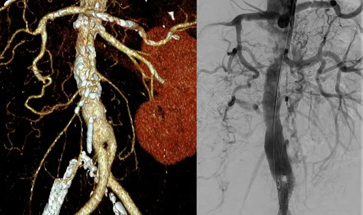 Visceral ischemia with aortic stenosis - Our daily dilemma: Open or Endo?