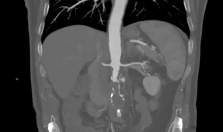 Complex aortoiliac occlusions