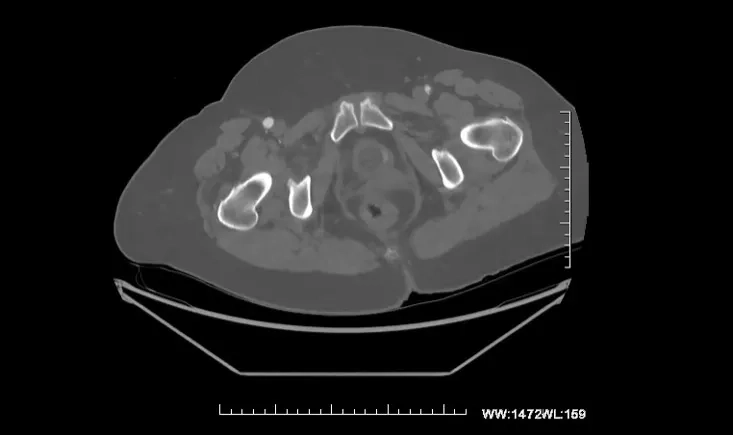 Acute limb ischemia on graft thrombosis and severe pancreatitis