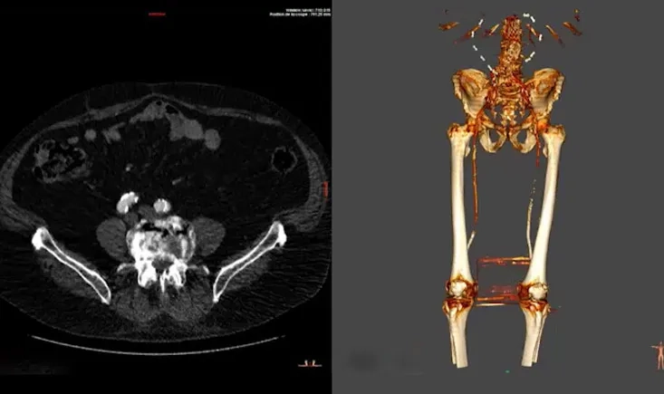 PAD with highly selective treatment for CLTI