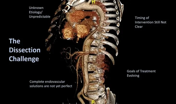 How can we improve outcomes in dissections and TAAA?