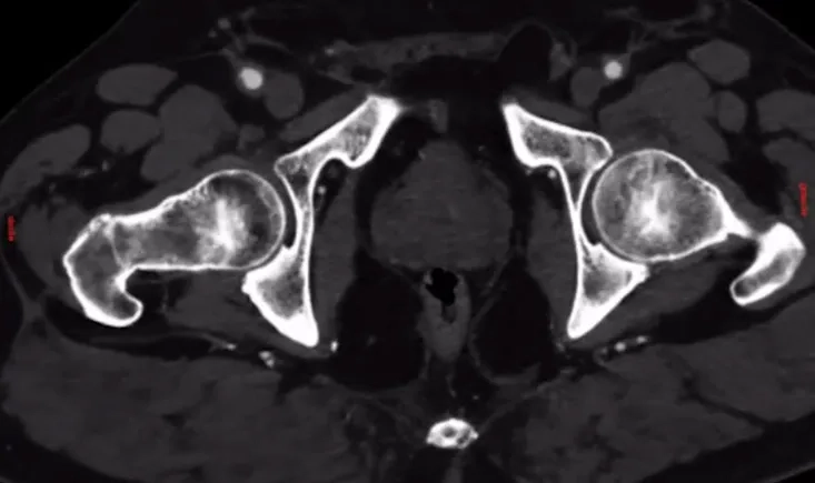 PAD with in-stent restenosis and calcified crossing management